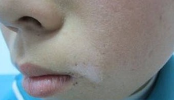 孩子患上白癜风该怎么护理？